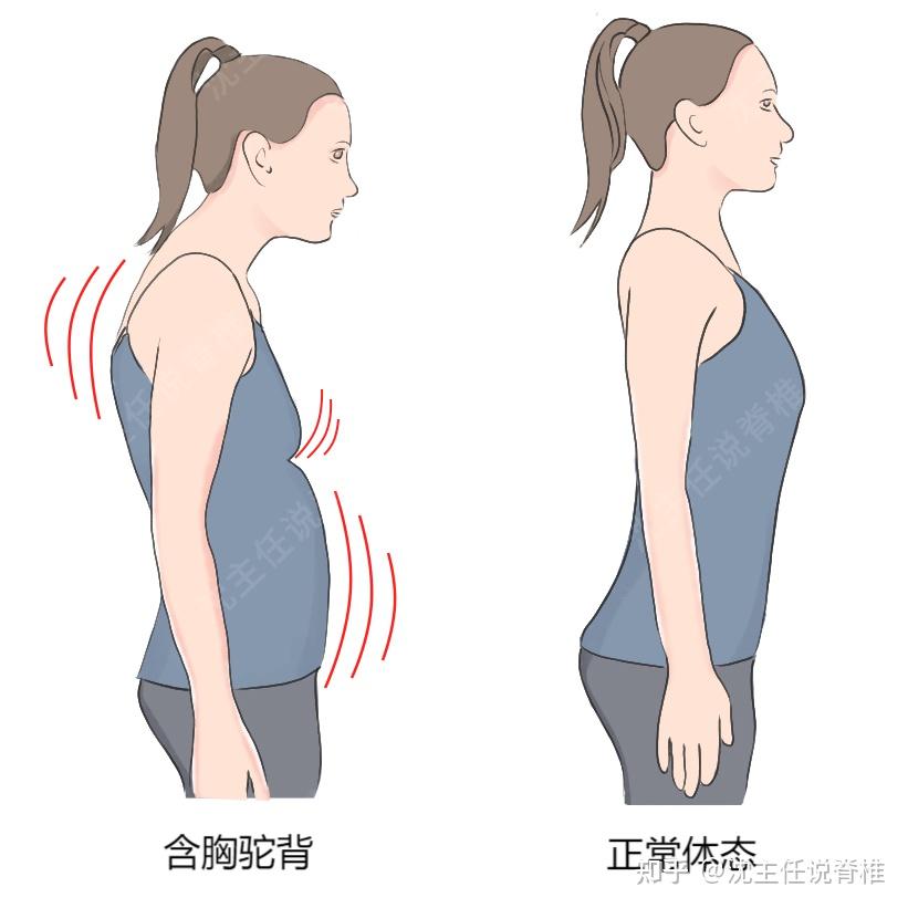 圆肩驼背、头前伸？让你气质减分的“上交叉综合征”该如何改善？ - 知乎