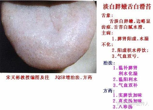 高清舌诊图解:各种临床证型舌象图谱大开眼界 - 知乎