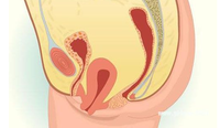 產後問題:子宮脫垂陰道壁膨出了怎麼辦