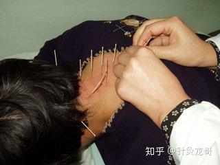 针灸流派这么多哪一流派最有用初学者该从何学起