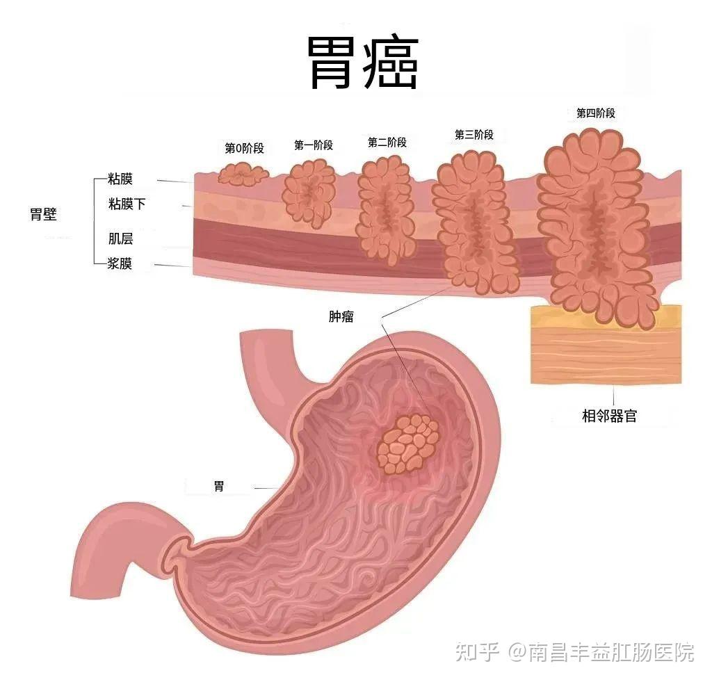 胃癌的症状和前兆图片