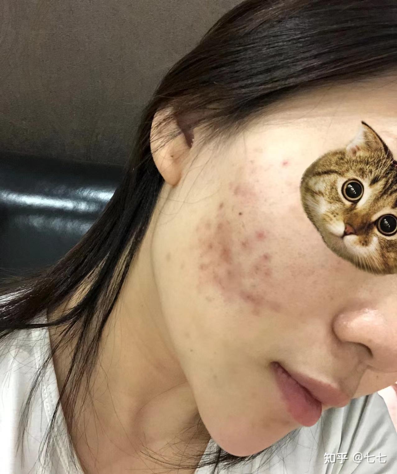 如何有效淡化脸上的痘印用去痘印产品是智商税吗盘点那些真正有用的