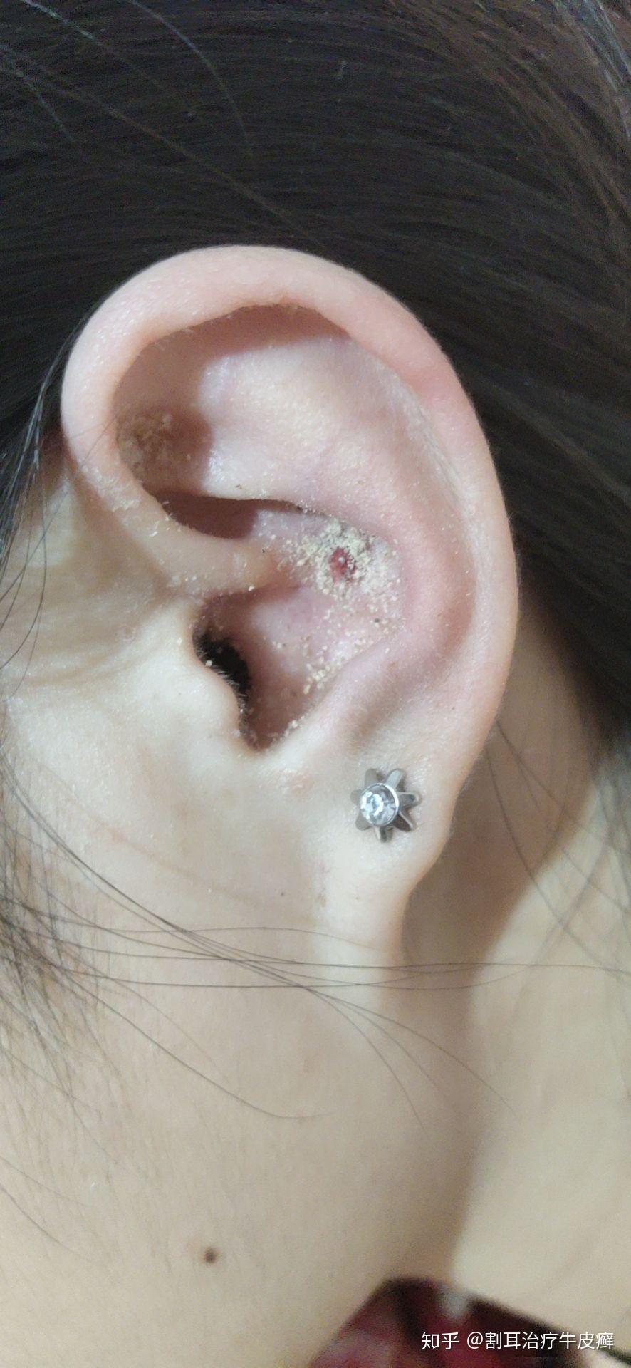 牛皮癣不用吃药不抹药也能在家自己治