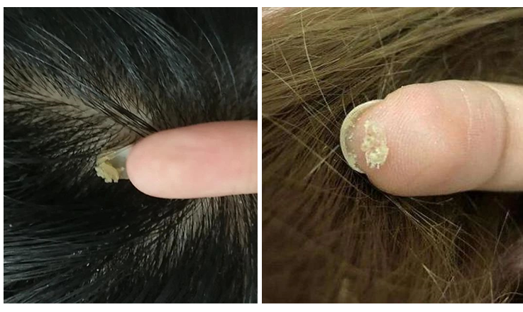 还会引发毛囊炎,头皮发红,长痘痘的现象,引起头皮屑的爆发.