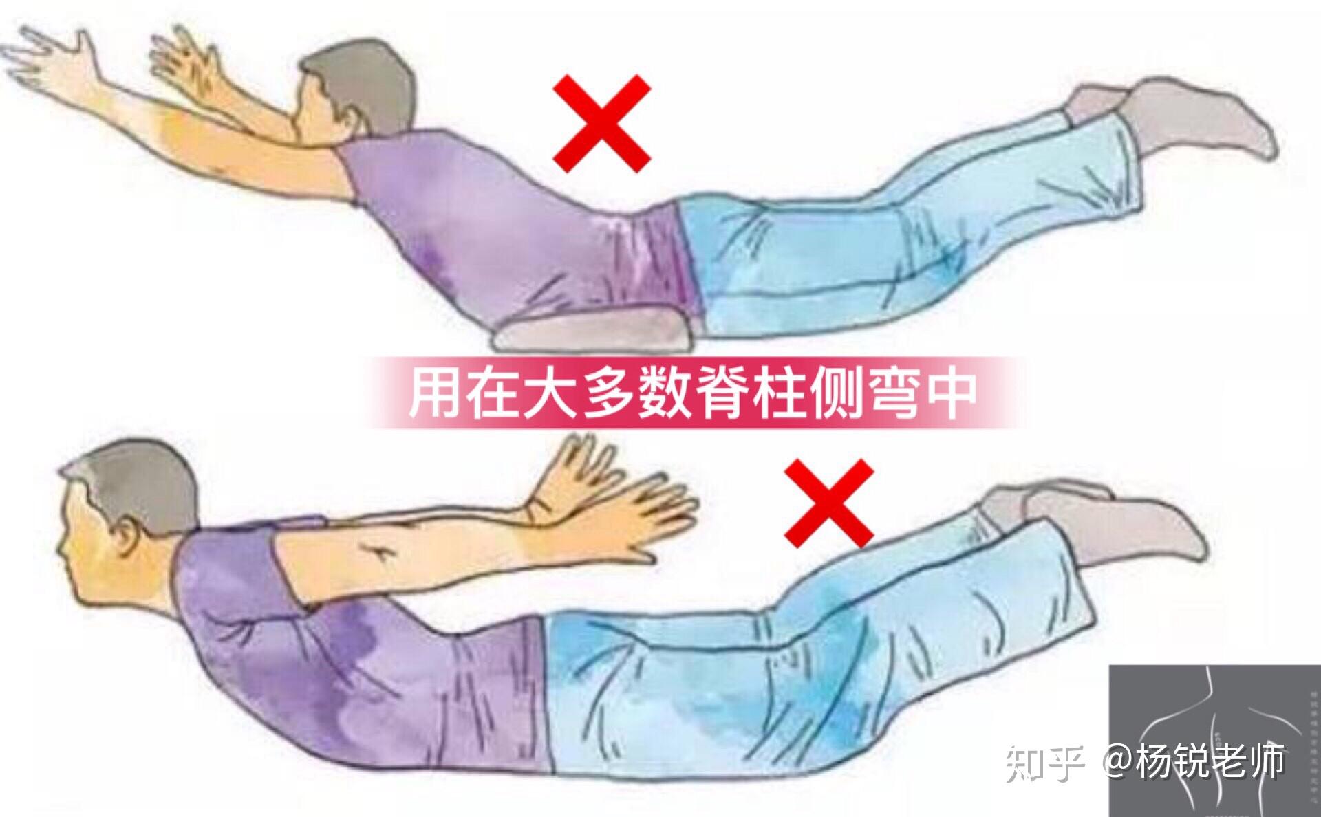形成身体的向后弯曲,而正常胸椎生理曲度是向后凸起,长期此类运动下