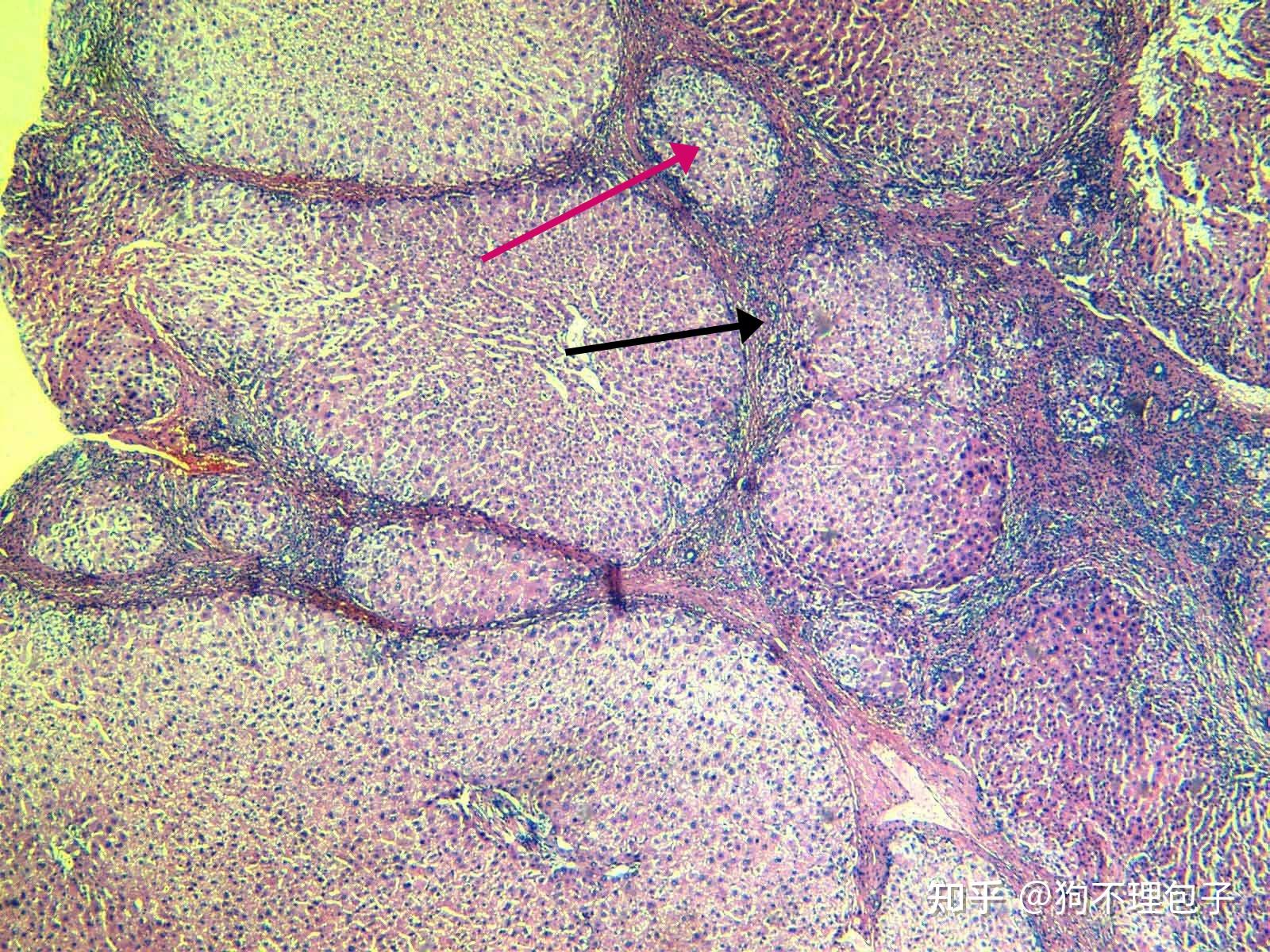 肝硬化  肝细胞排列紊乱