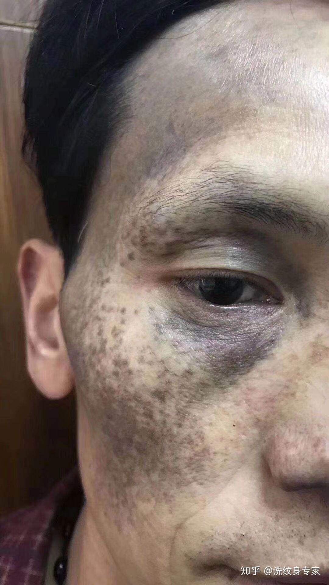 疤脸部黑色胎记