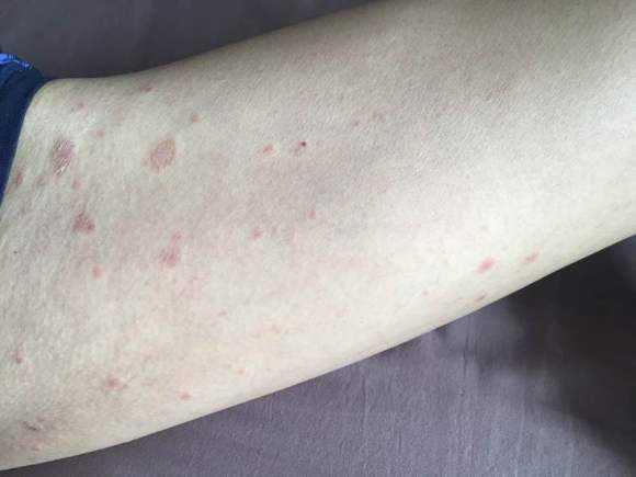 郑州皮肤科秋冬季节容易发作的皮肤病玫瑰糠疹