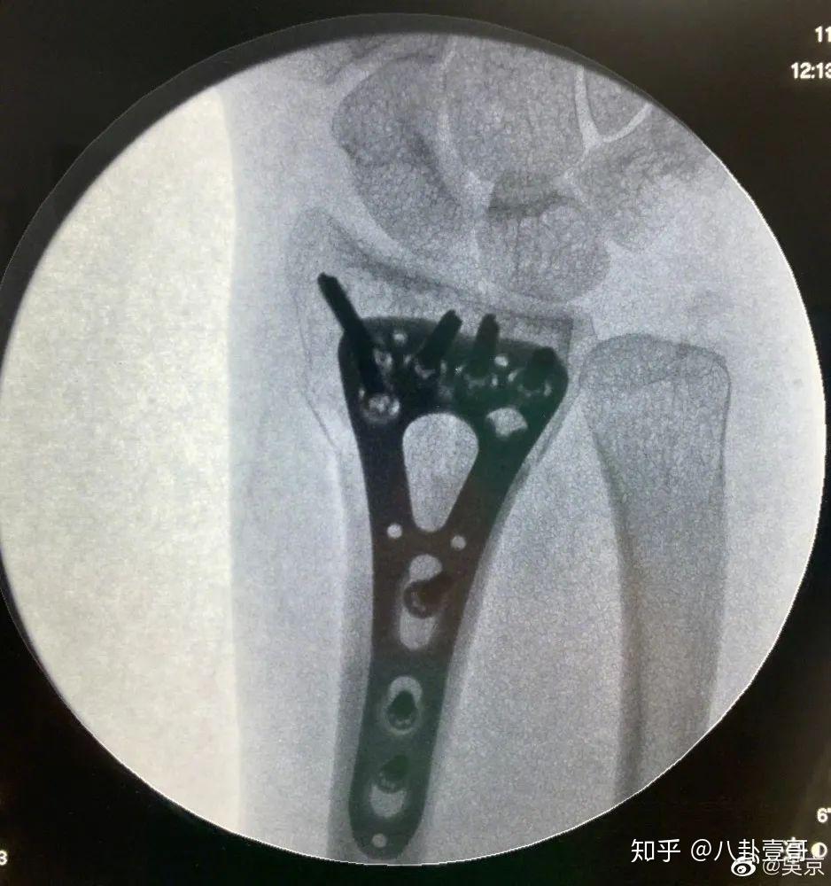 心疼老婆晒谢楠骨头里的钢钉?