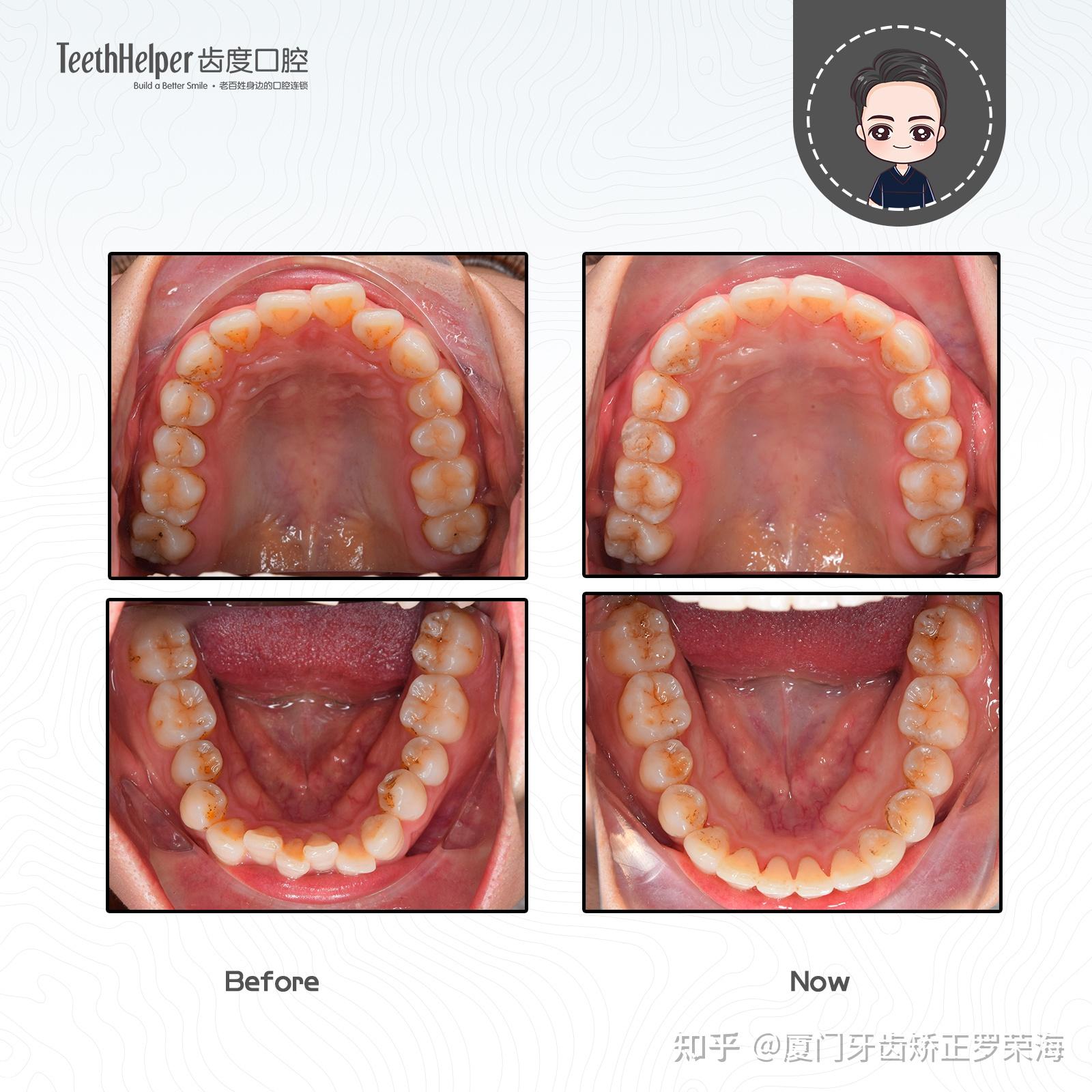 廈門牙齒矯正擁擠中線不齊鎖頜鄰面去釉