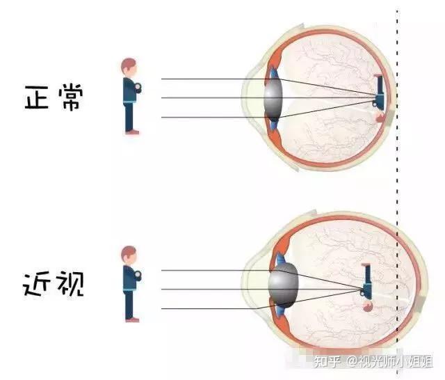 随着年龄增长近视和老花眼是否可以相抵消以后是不是就不用戴眼镜啦