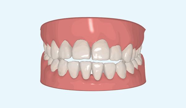 牙齿咬合不到一起这是病得治