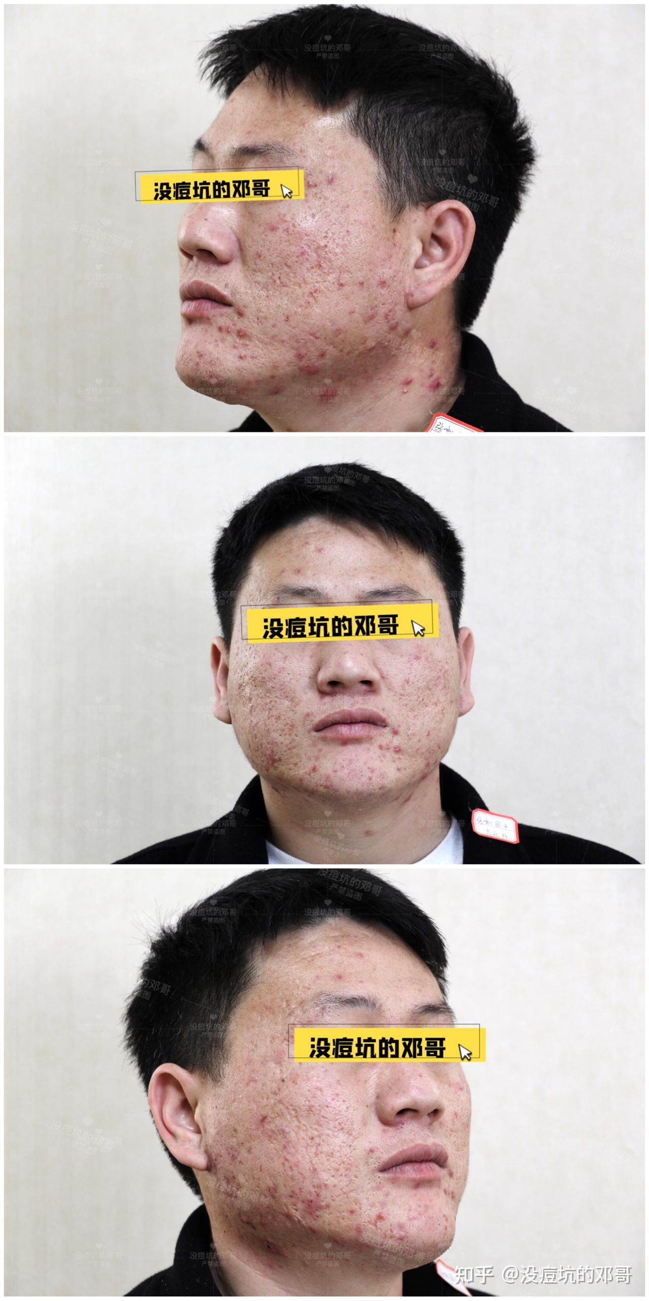 男生怎样才能减少脸上的痘痘 痘印？ - 知乎
