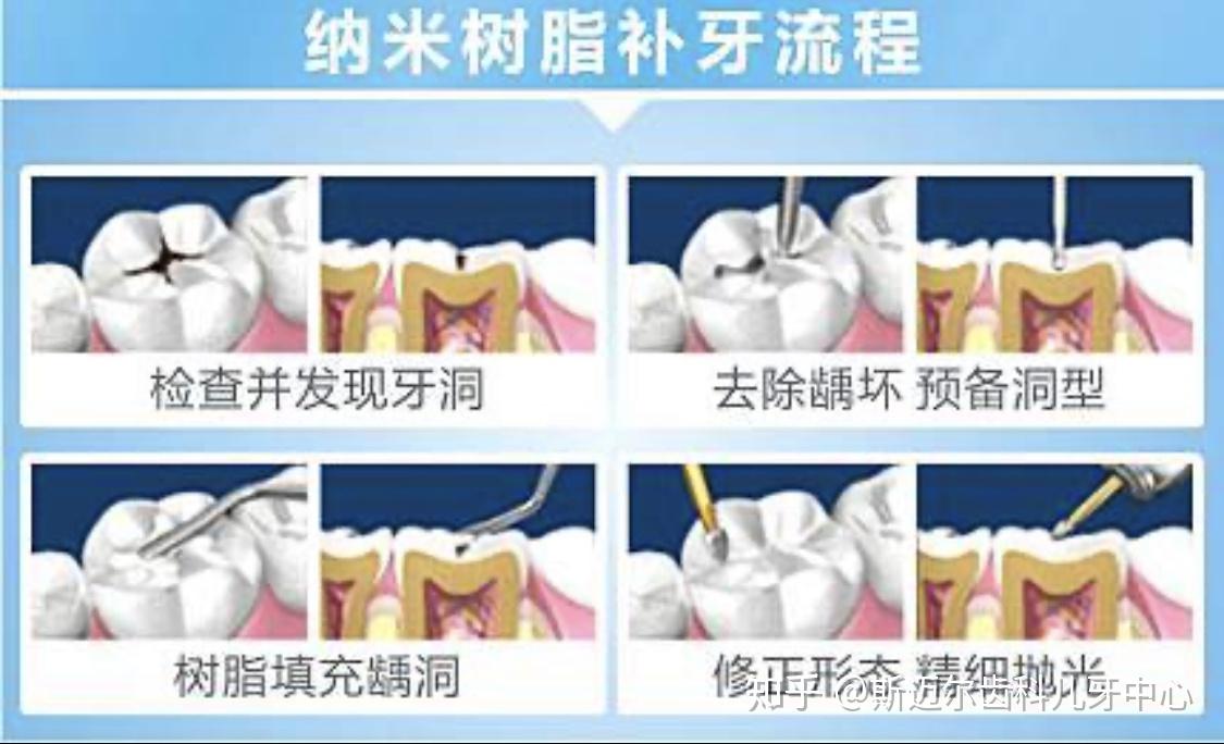 复合树脂是汞和银锡合金粉相互作用的汞齐化合物,多用于需承受牙合力