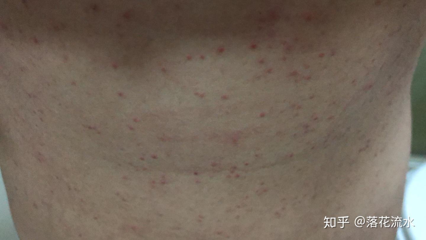 皮肤出红疹，又不敢去医院，到底这是什么啊？ - 知乎
