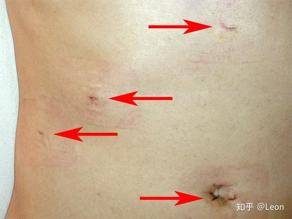 胆囊切除术cholecystectomy 知乎