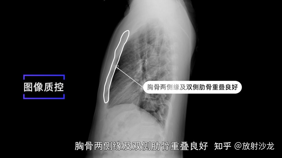 X线规范化检查 | 胸部正侧位摄影 - 知乎