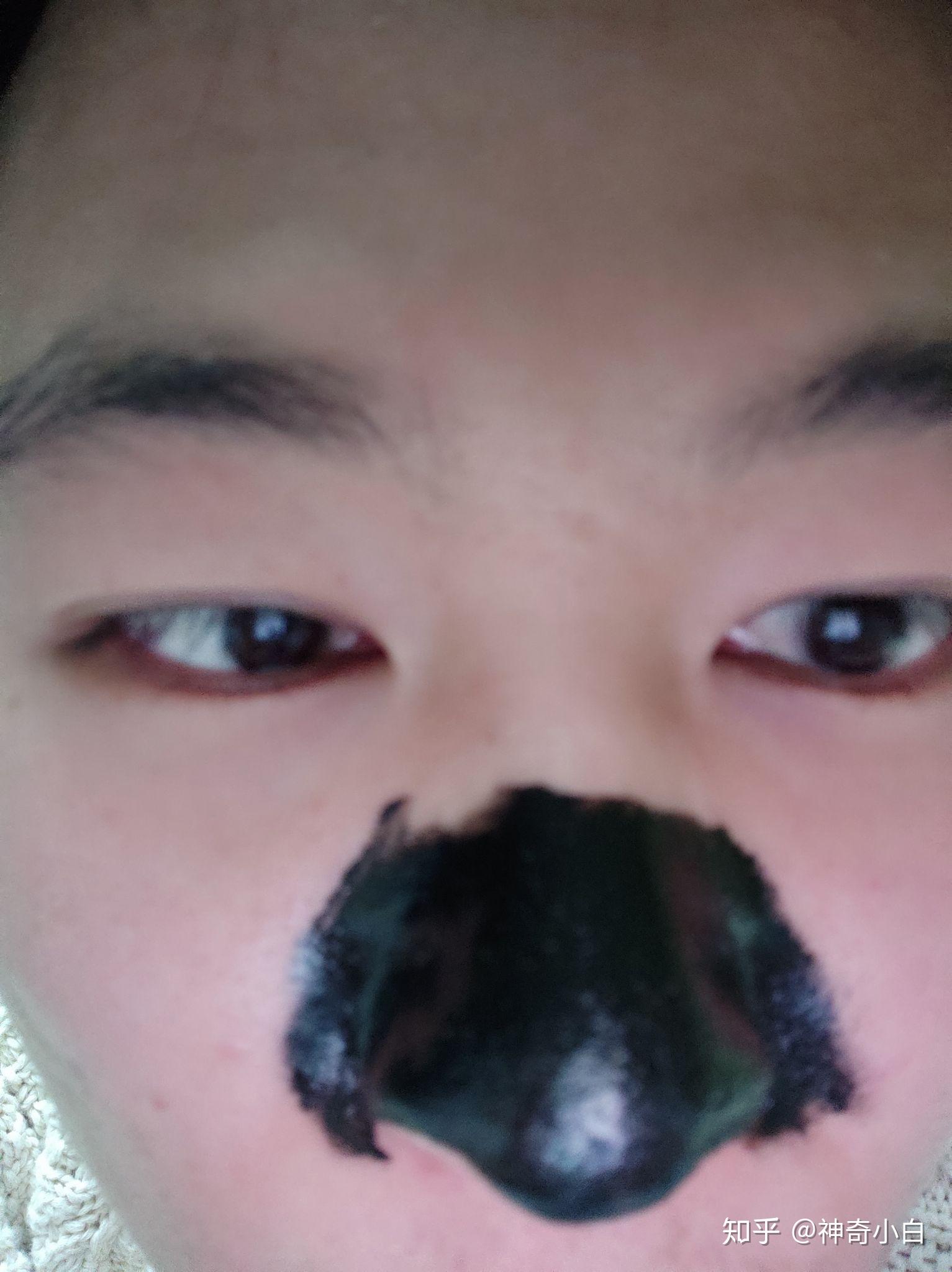 李医生去黑头的如何?