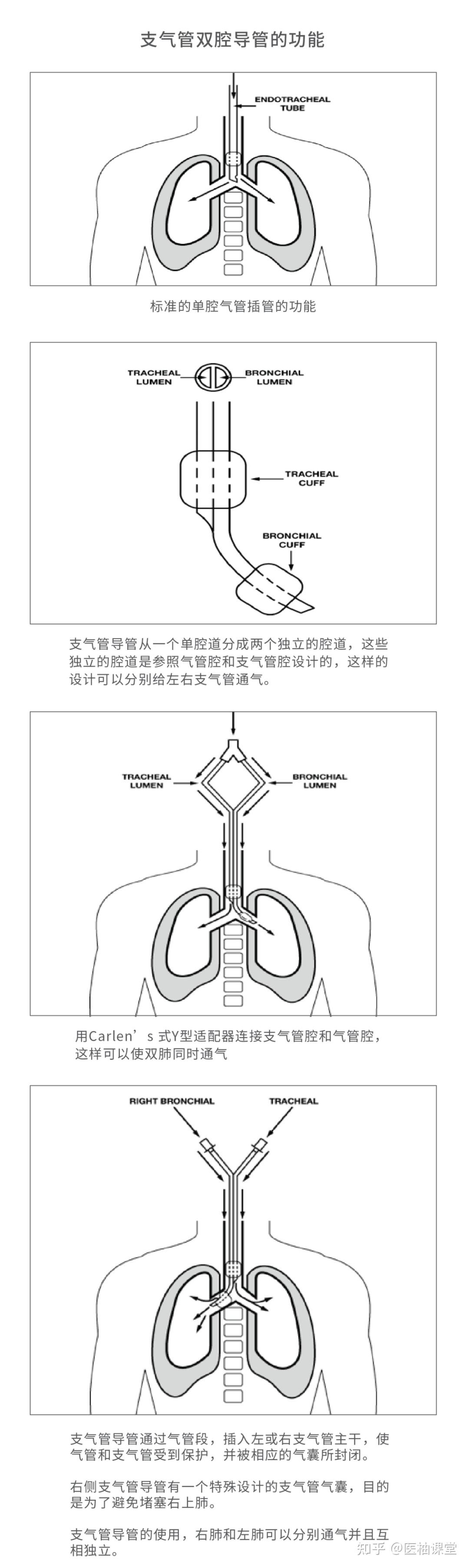 支气管双腔插管