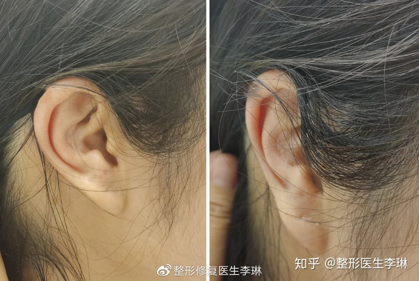 耳软骨隆鼻后耳朵变形如何正确取耳软骨