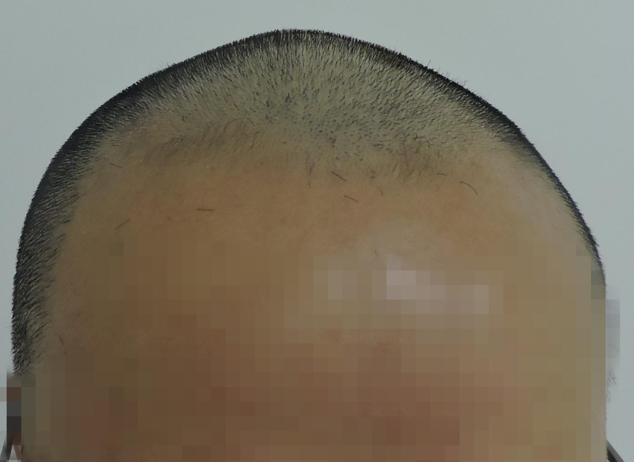 为什么秃顶的人这么多很少有做植发的?