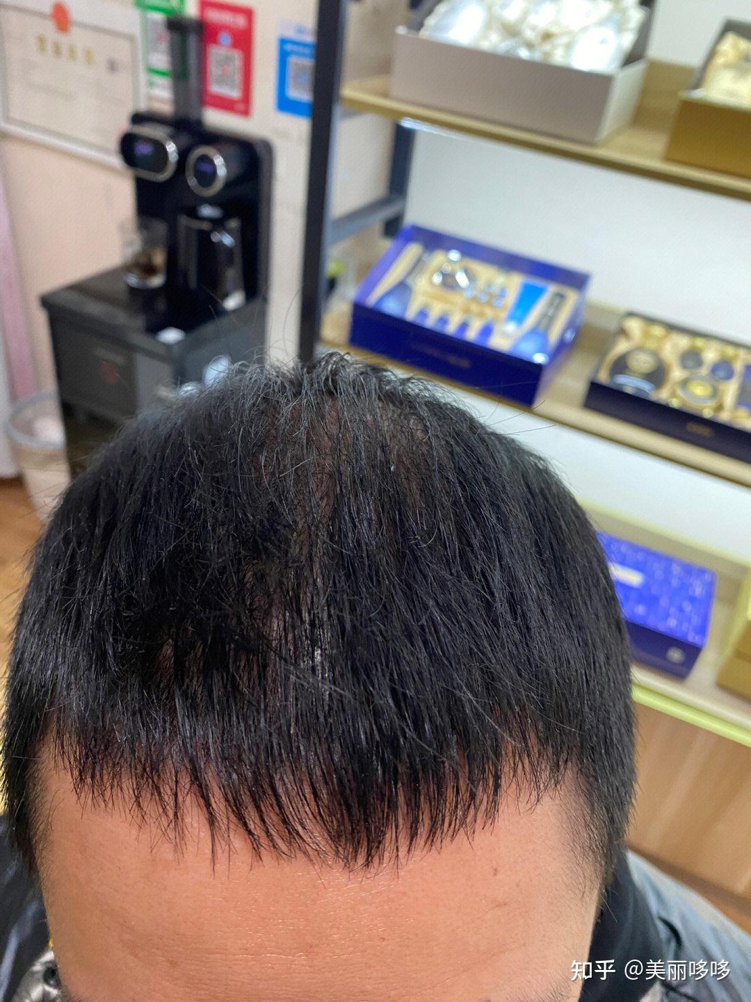 艾斯植发(植发的坏处和后遗症)