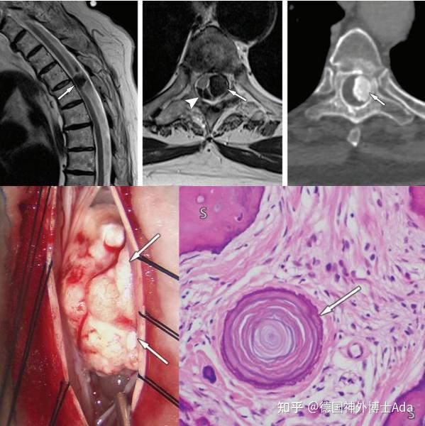 六大椎管内硬膜下肿瘤影像特点及手术策略解析 知乎