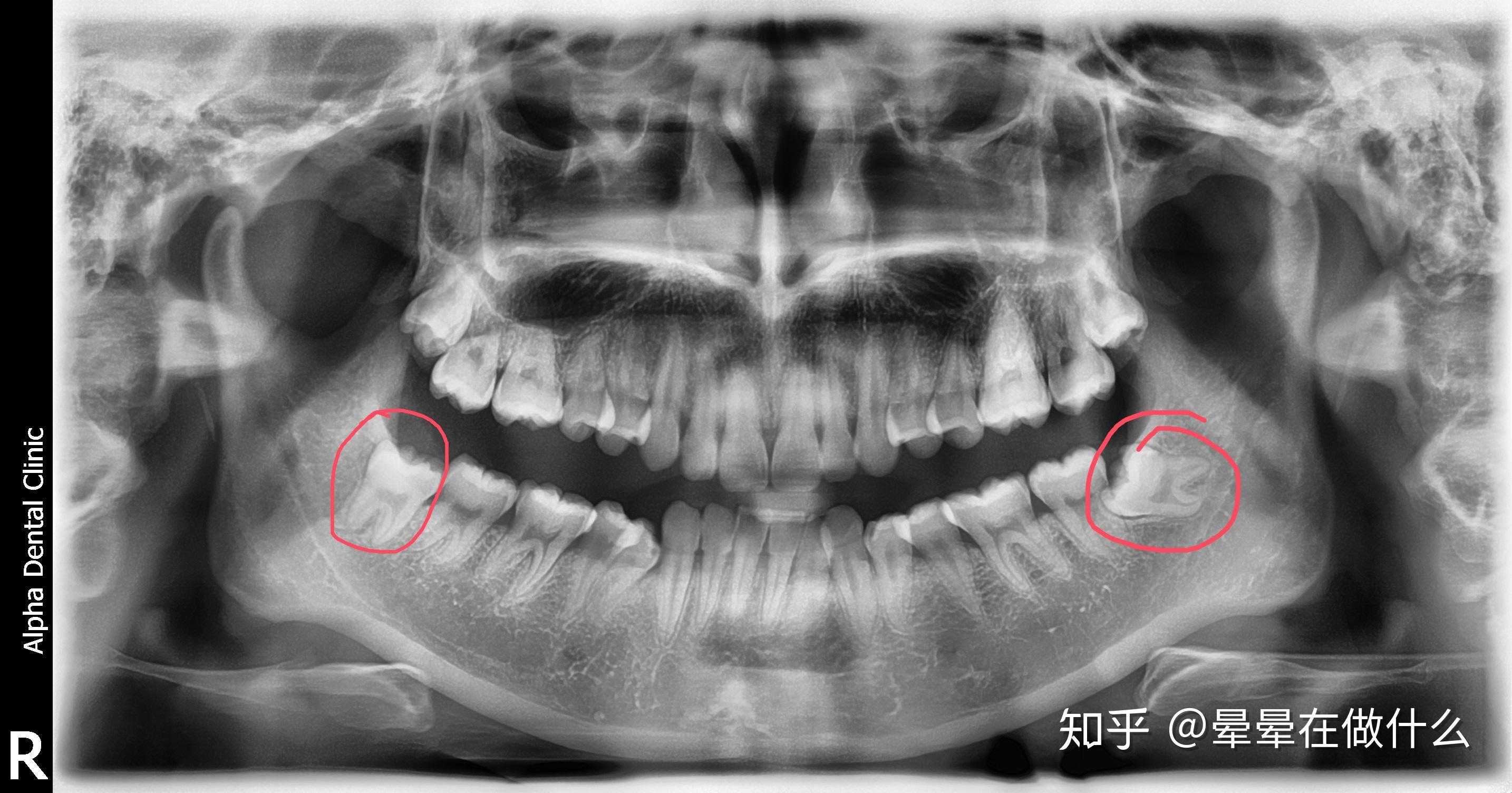 拔智齿阻生牙国内外对比!