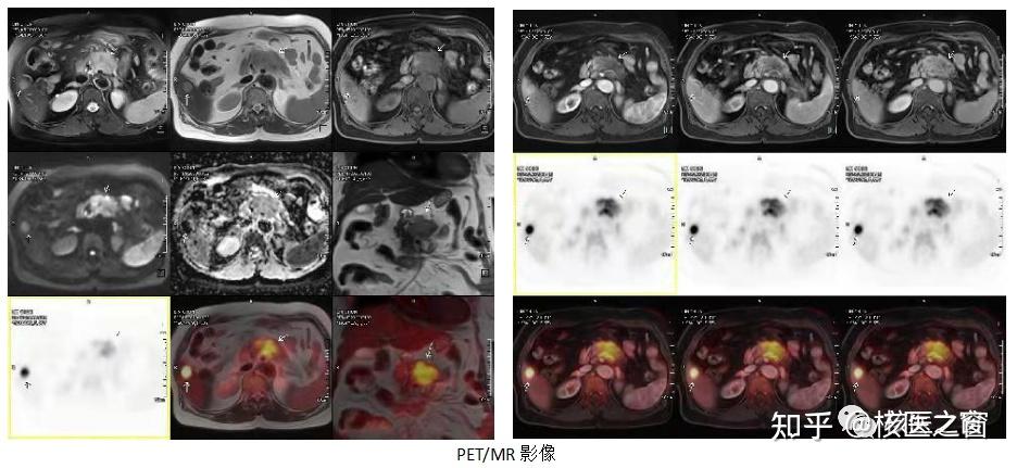 多模态,一体化的pet/mr来帮你搞定! - 知乎
