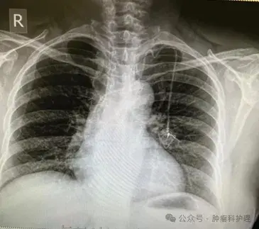 一例输液港导管堵塞的护理经验分享