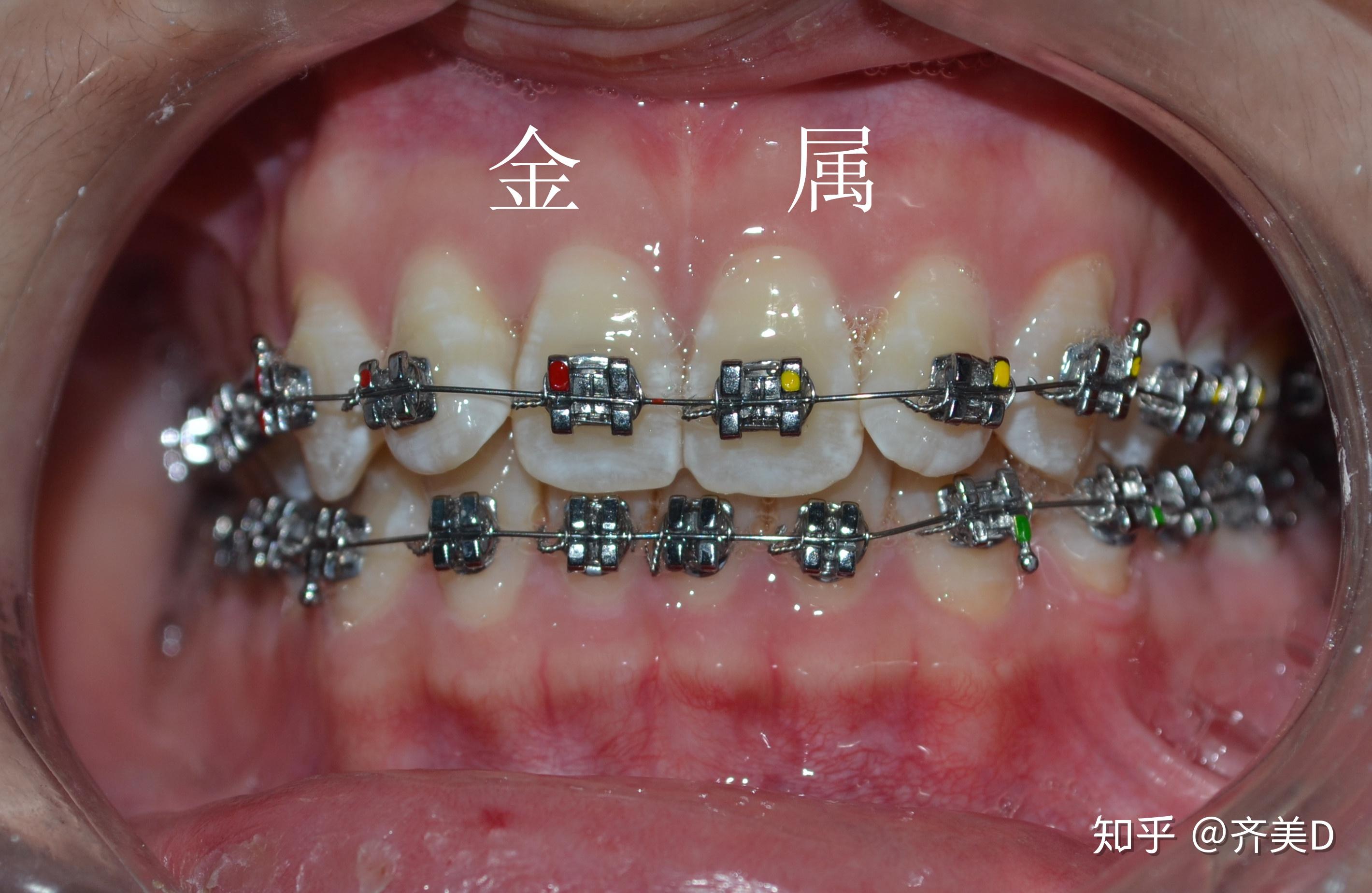 正畸八字结扎图片