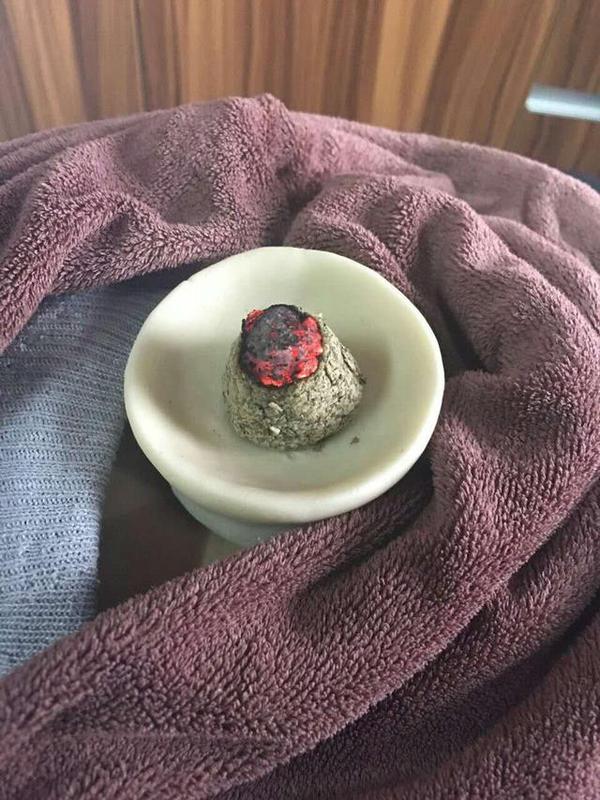 2,脐灸面碗灸法