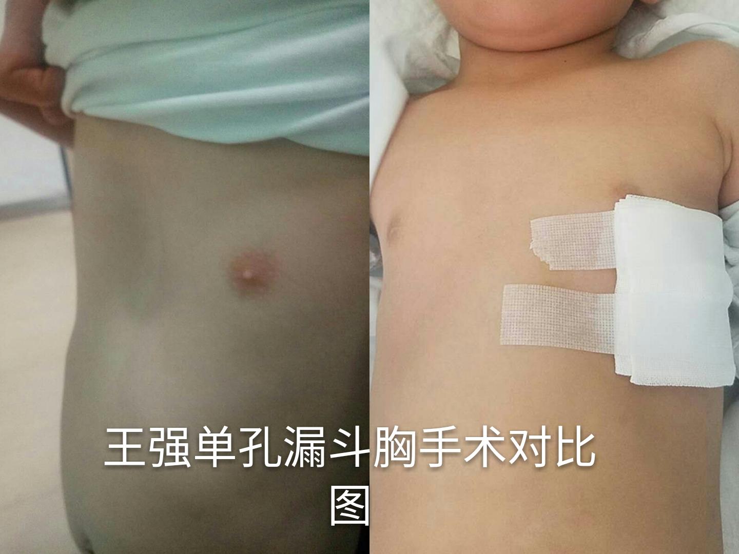 案例分享 单孔漏斗胸矫正术治愈四岁漏斗胸患者 知乎 案例分享 单孔漏斗胸矫正术治愈四岁漏斗胸患者 知乎
