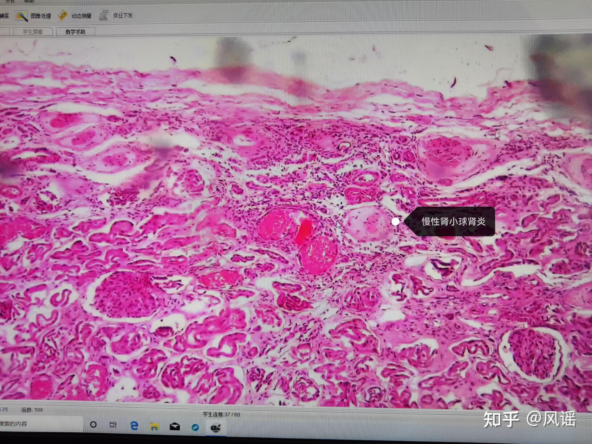 病理学实验切片观察画图 肉芽组织肺淤血 阑尾炎 肿瘤 - 知乎