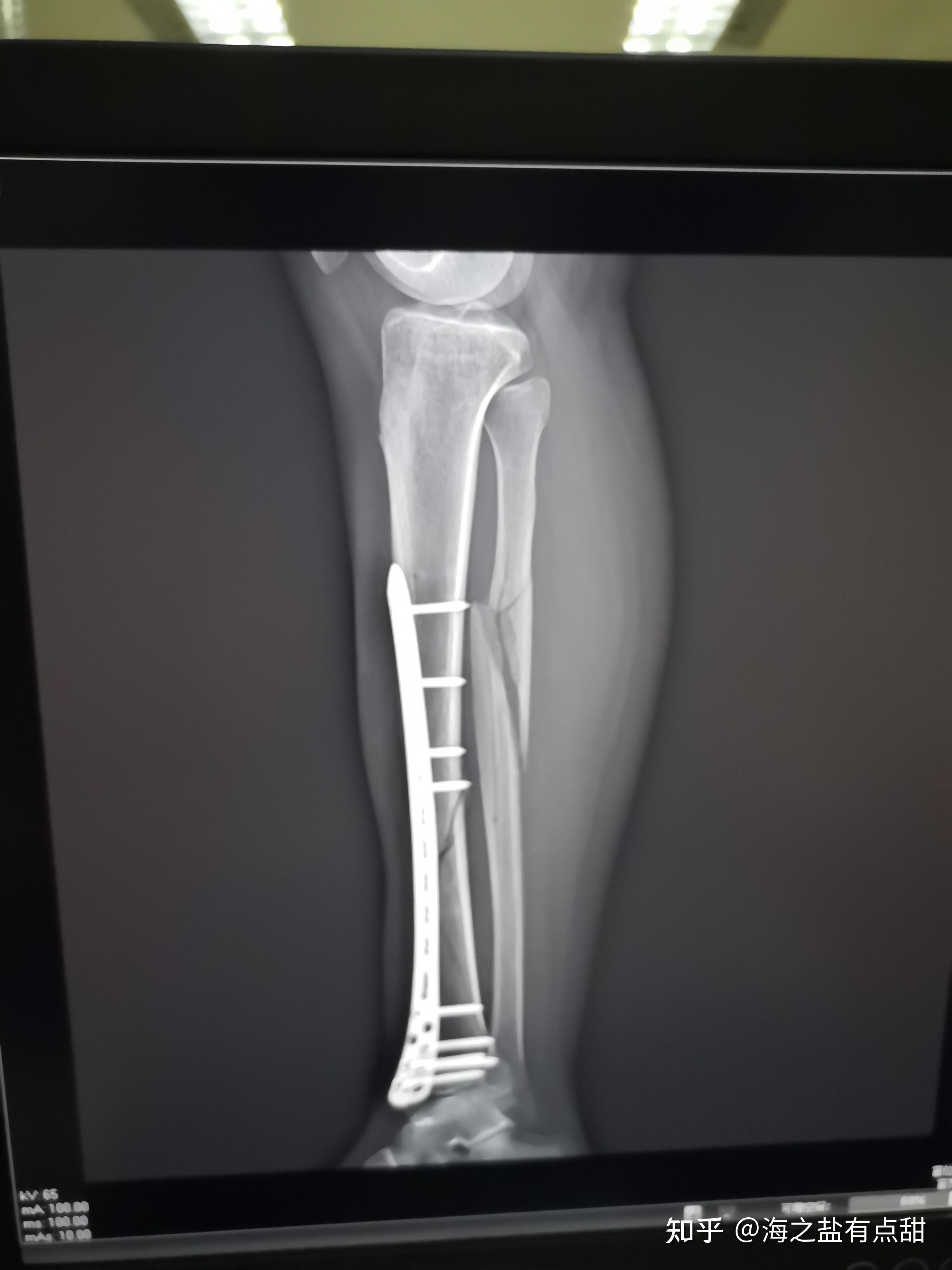 记录小腿胫腓骨骨折经历