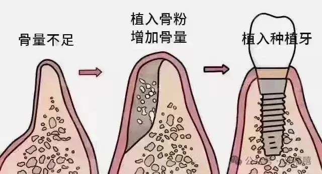 骨增量手术其实是种牙路上最可怕的隐藏关卡 - 知乎