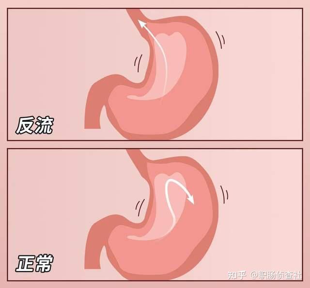 反酸烧心别大意，可能是这道“门”没关紧！ - 知乎