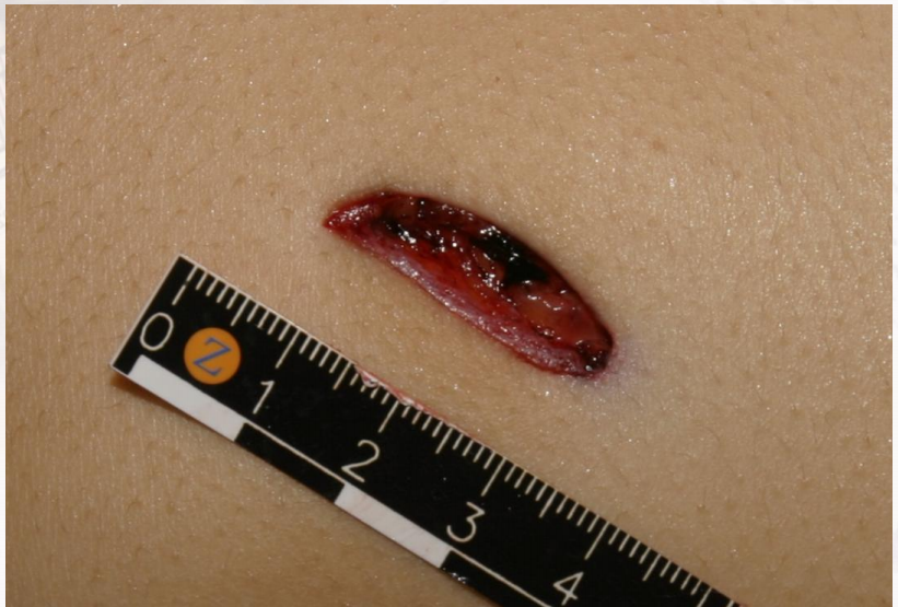 锐器伤之刺伤谈谈凶案排行第一的凶器