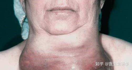 面对你我们总有些无奈甲状腺癌中的王者甲状腺未分化癌