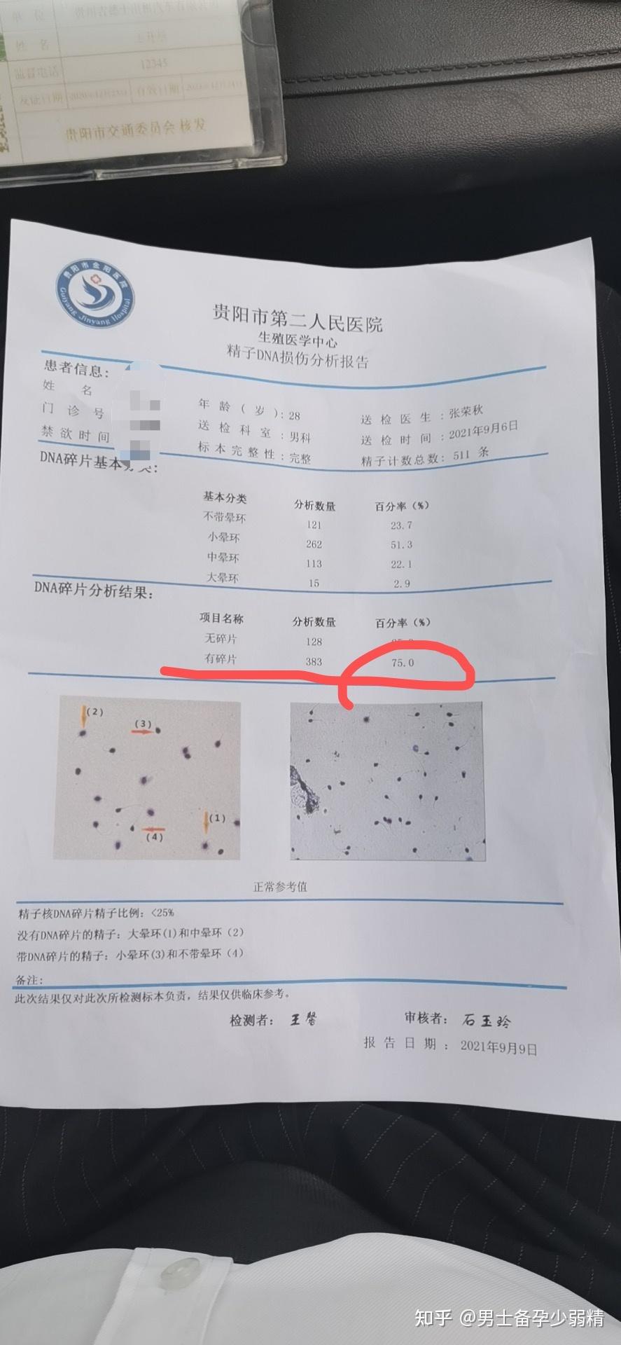 精子dna碎片75%,已经好了,复查结果达标 - 知乎