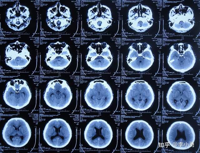北大才子三室内肿瘤切除后,因脑积水10个月内在北京多家医院经6次手术