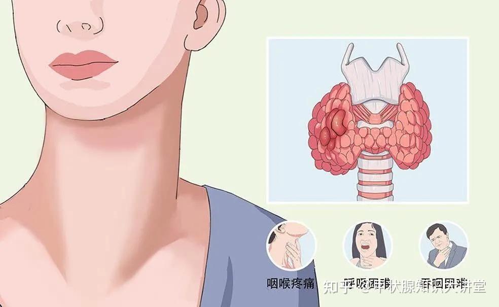 哪种甲状腺结节可以不用管医生结节拖成癌多半是这两个原因
