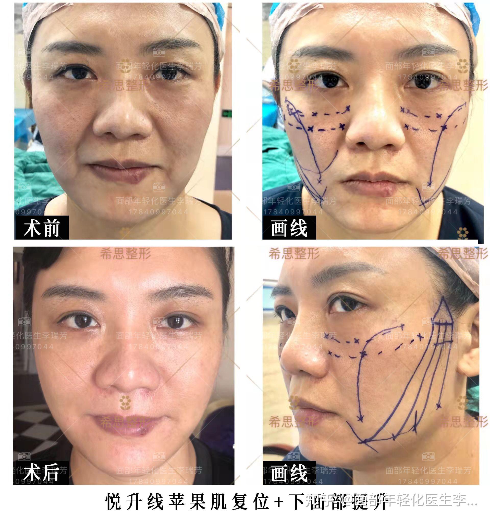 面部提升术：日本「美魔女大赛」52岁阿姨颜值逆天夺冠！