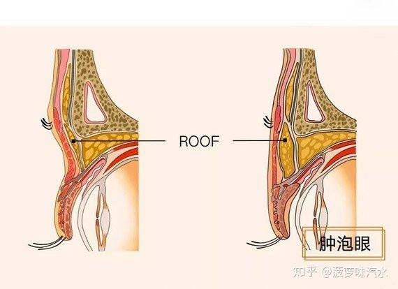 oculi fat)眼轮匝肌后脂肪,亚洲人大概率是roof层过厚,需全切双眼皮