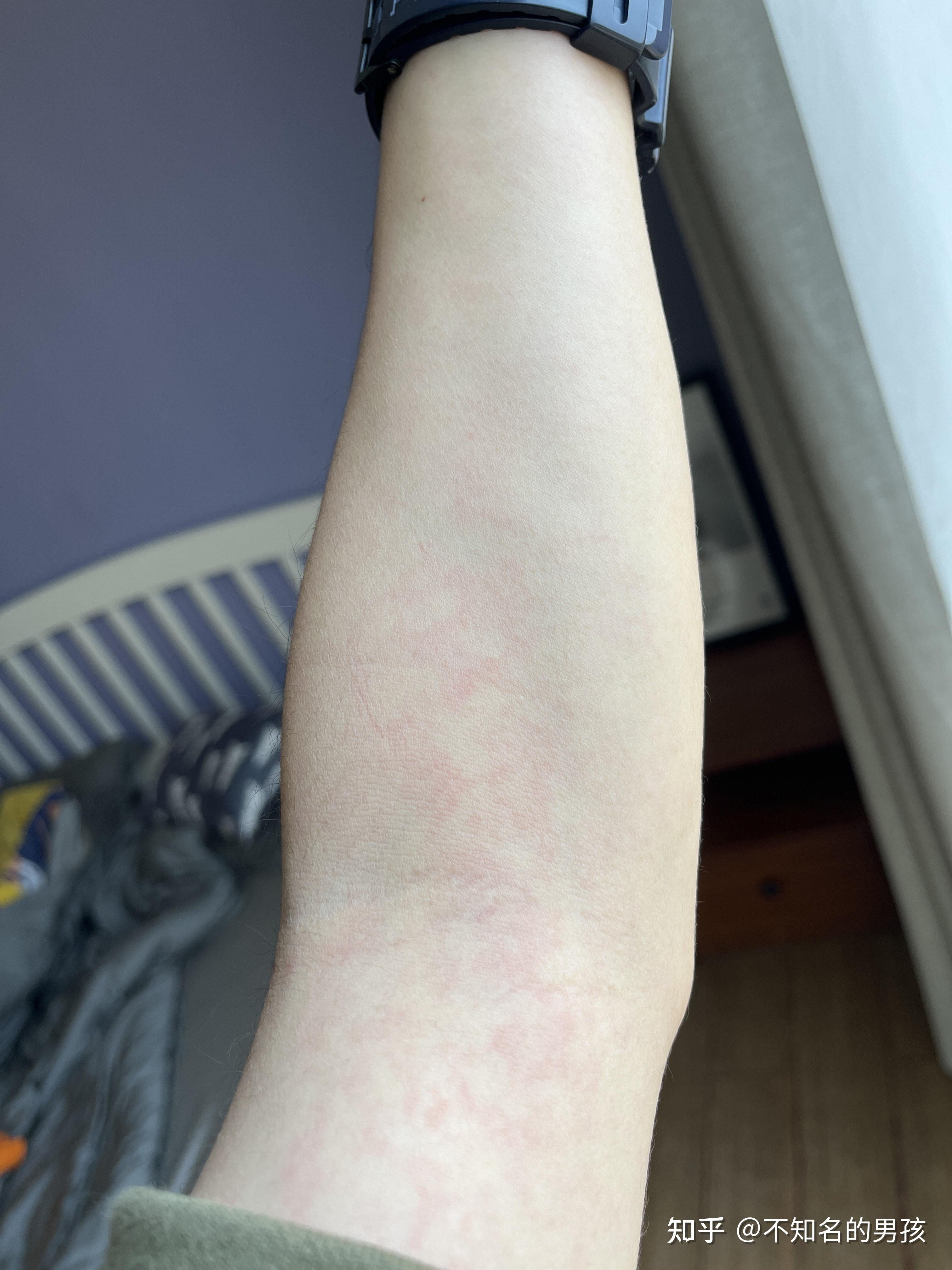 梅毒就这么一瞬间的事