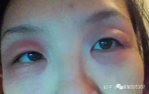为什么过敏的时候脸和眼睛会肿 脸过敏然后眼睛肿了 德涵网