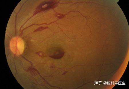 白血病性眼底改变(leukemia retinopathy)