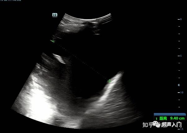 胸腔积液的超声诊断,既简单又复杂