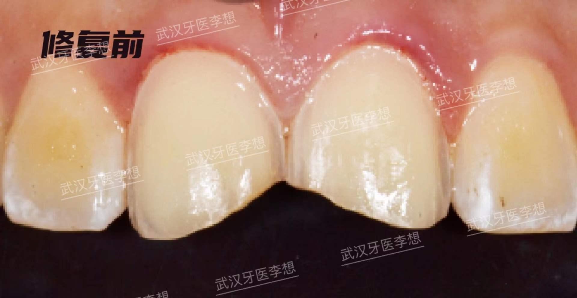 溫暖您的笑容｜李偉瑄牙科醫師: 門牙美觀區重建（十二）牙齒缺角變色