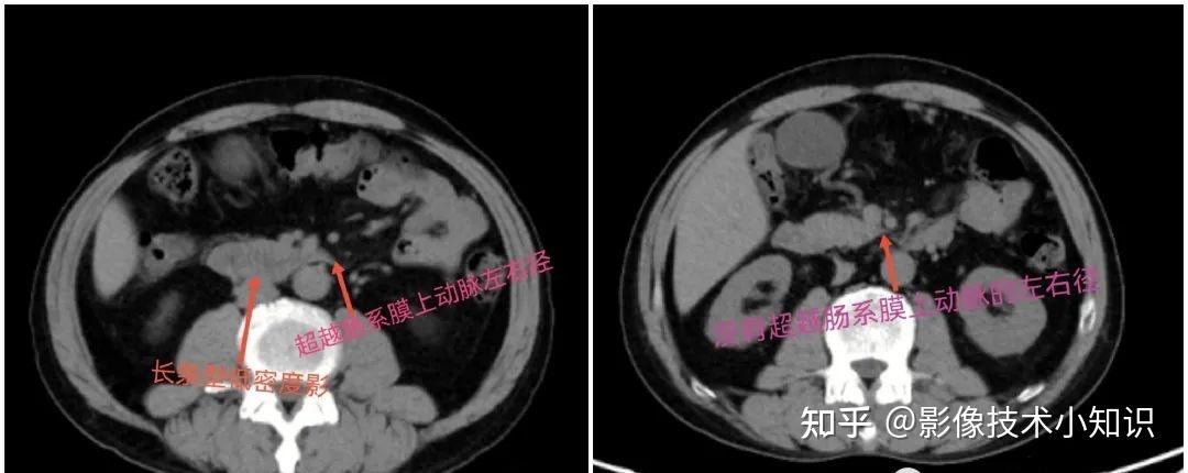 胰腺影像解剖 - 知乎